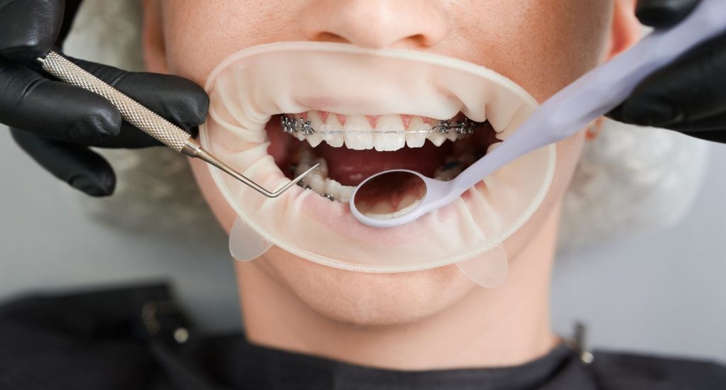 female-patient-with-braces-on-teeth-receiving-orth-2025-01-16-22-28-24-utc